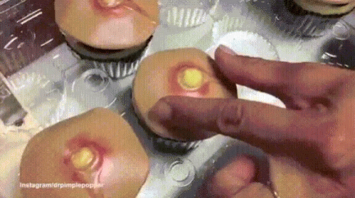 Pimple Cup Cake